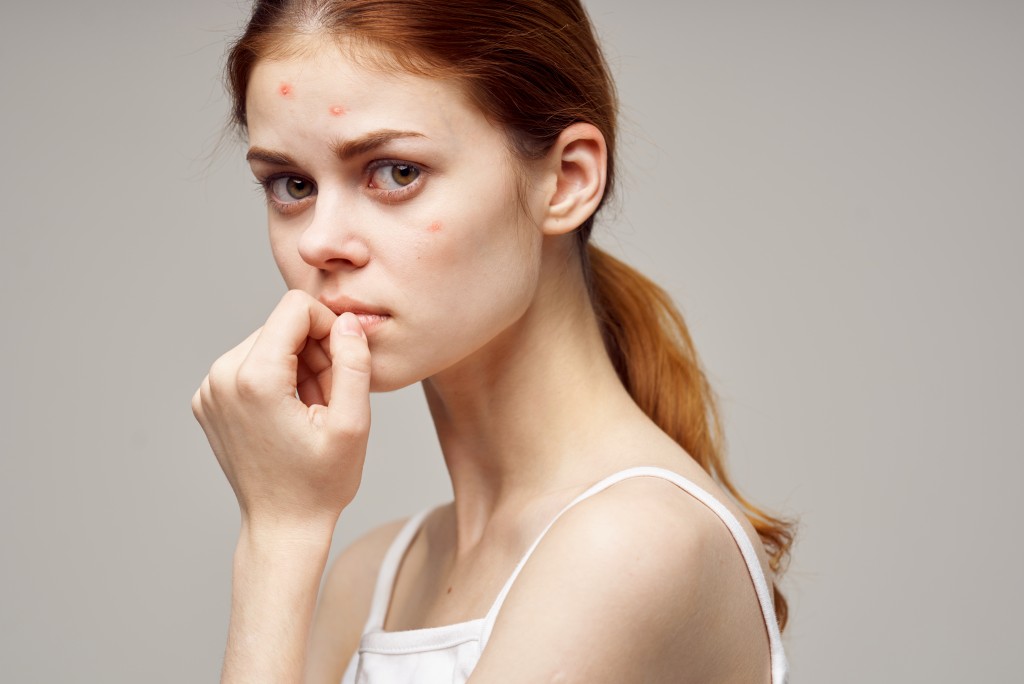 woman with pimples on face