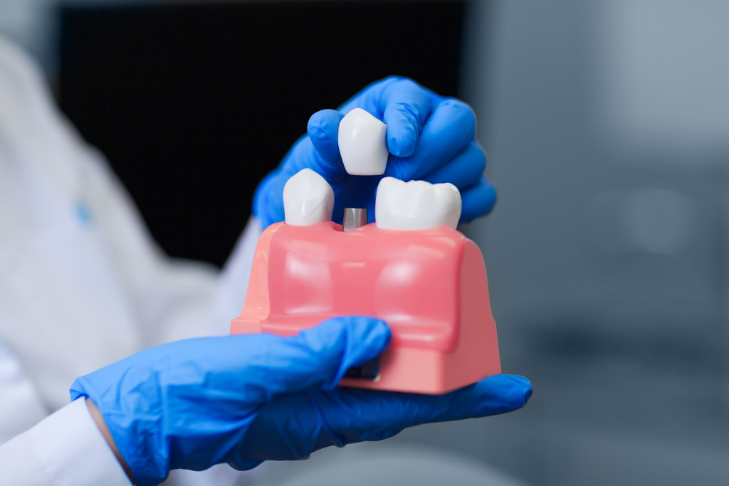 dentist holding dental implants in model